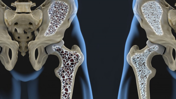 Риск остеопороза Кому грозит остеопороз