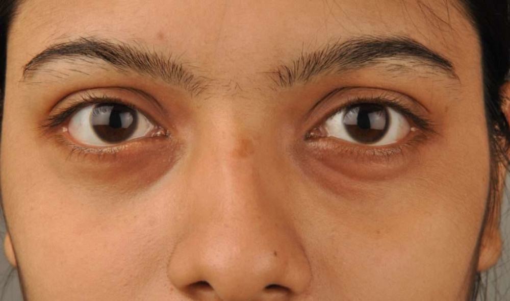 Как избавиться от кругов под глазами?