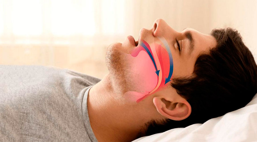 Что будет, если постоянно дышать ртом?