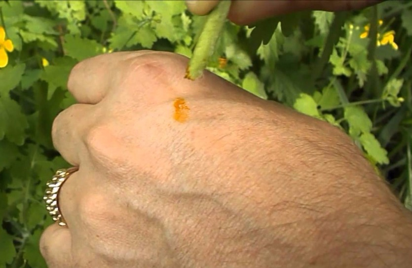 Как удалить бородавки, фото 1