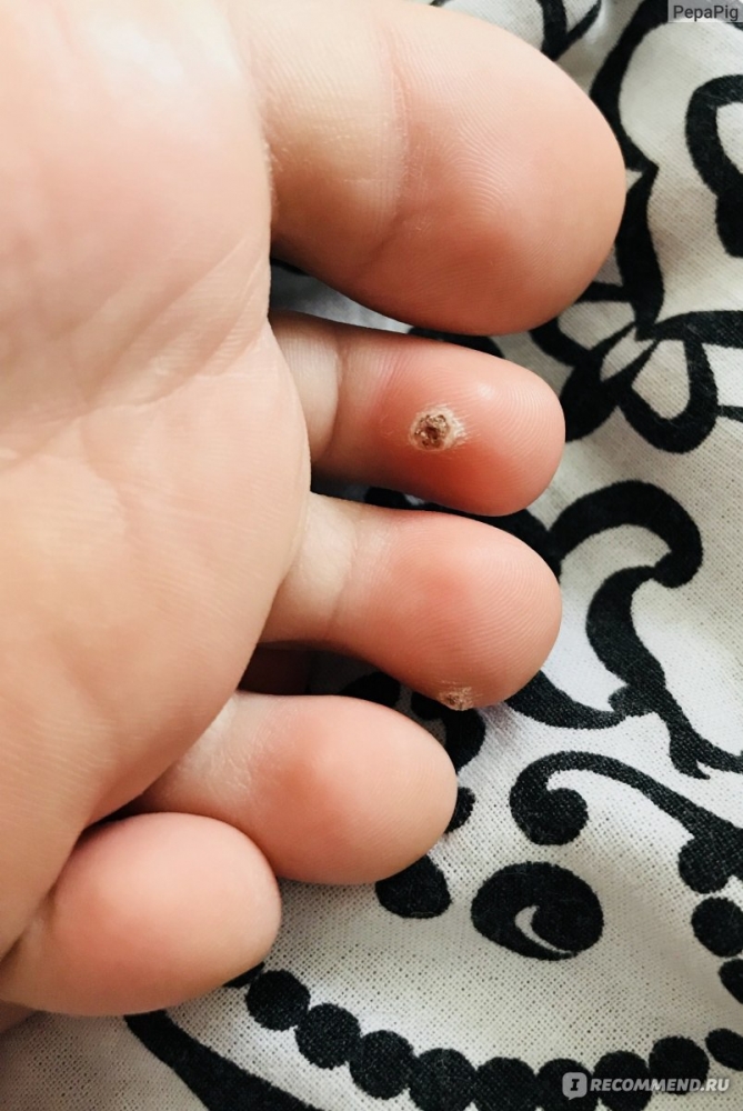 Как удалить бородавки