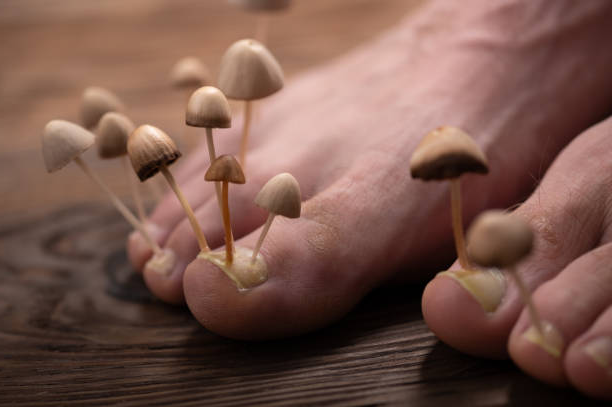 Как распознать грибок на ногах?