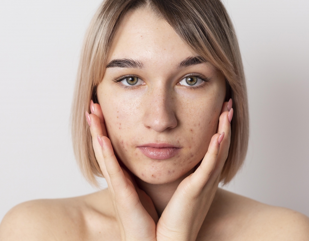 Как избавиться от акне?
