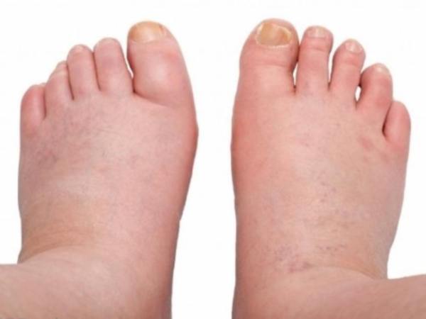 Почему отекают ноги?