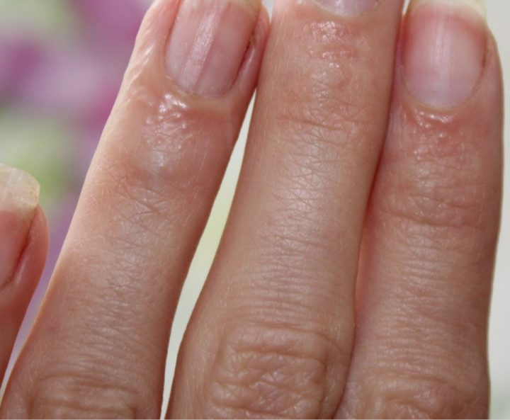 Аллергия на гель лак