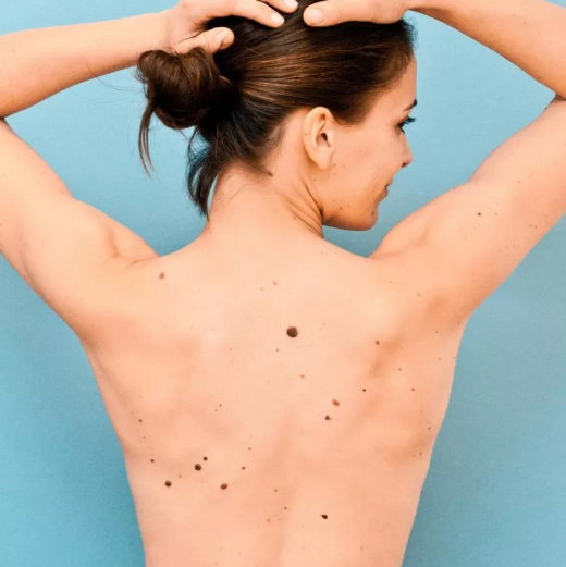 Можно ли удалять родинки на теле