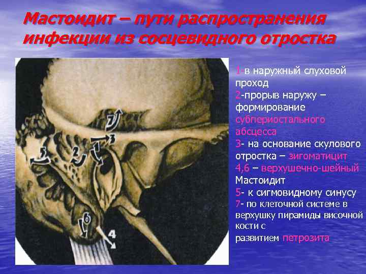 Что такое - Абсцесс наружного уха?