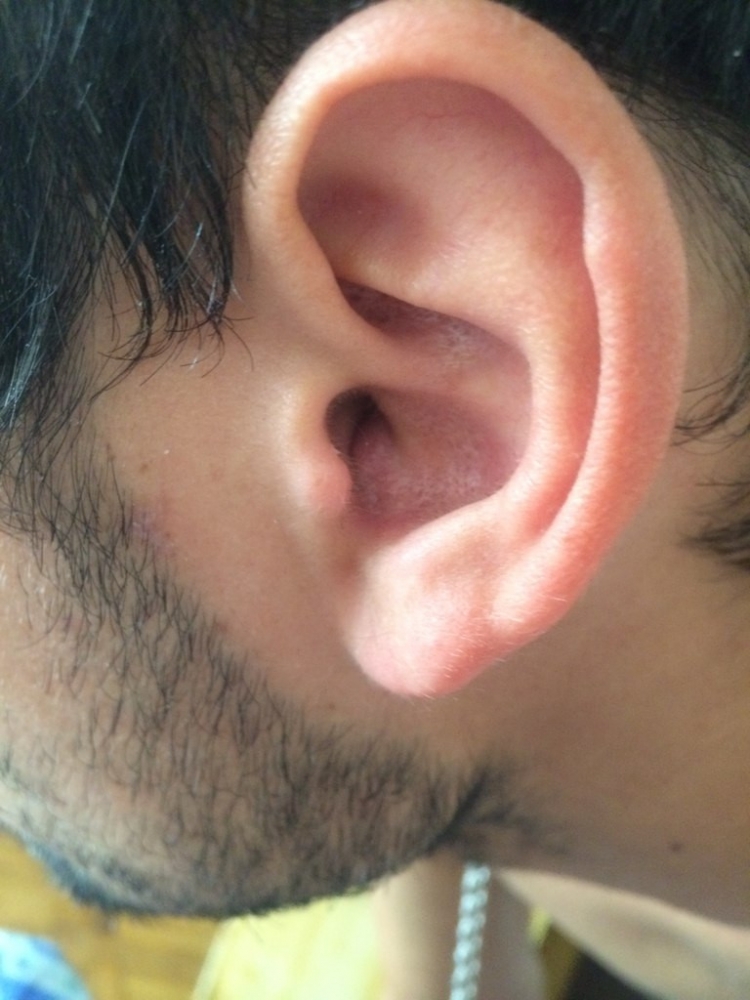 Что такое - Абсцесс наружного уха?, фото 2