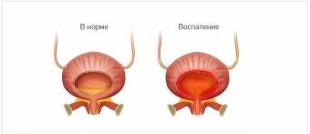 Понятие о цистите и терапия воспалительных заболеваний мочевого пузыря
