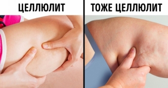Нет апельсиновой корке – аминофиллин против целлюлита