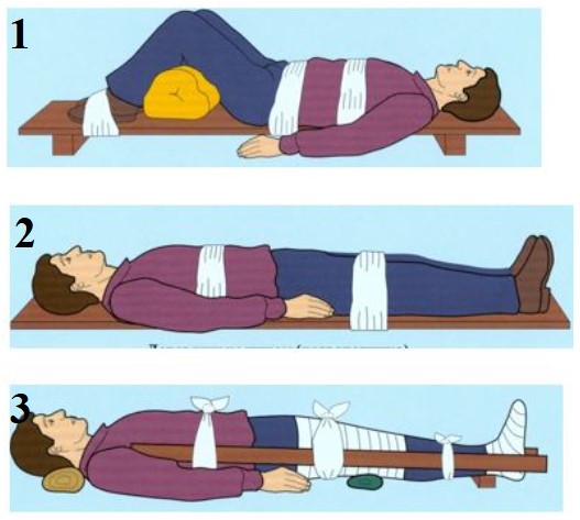 Перелом позвоночника оказание помощи. Транспортировка больного с подозрением на перелом позвоночника. Транспортировка при переломе позвоночника. Транспортировка больного с переломом позвоночника. При переломах позвоночника больного транспортируют.