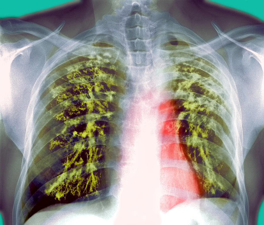 К неотложным состояниям при туберкулезе легких относятся: