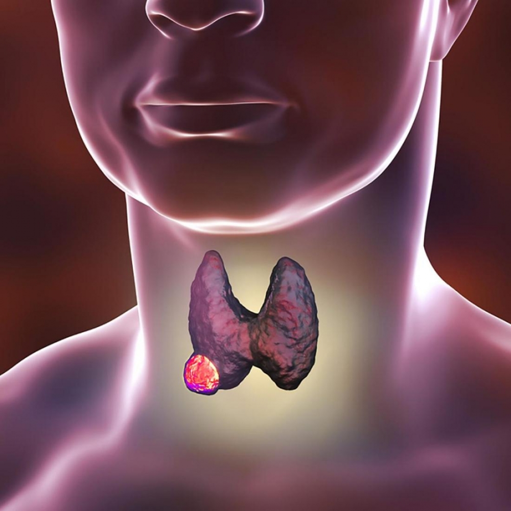 К этиологическим моментам возникновения рака щитовидной железы следует относить: