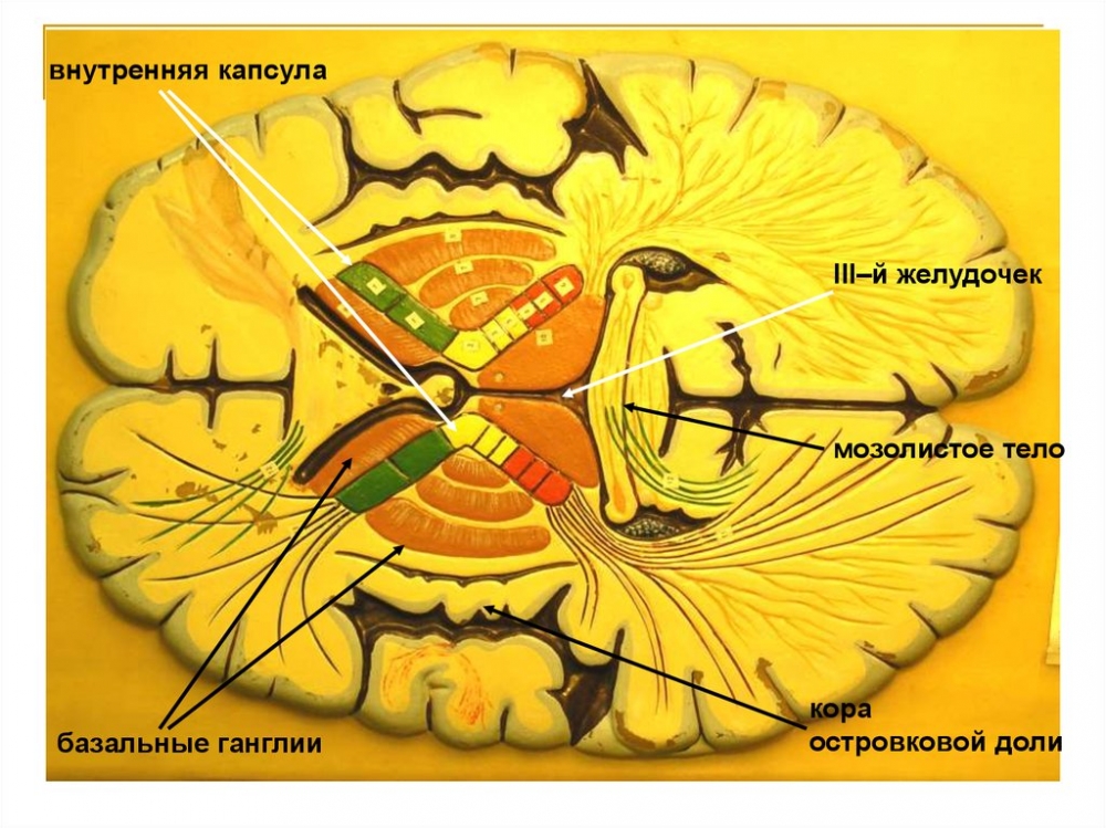 Внутренняя капсула анатомия клиническая картина поражения