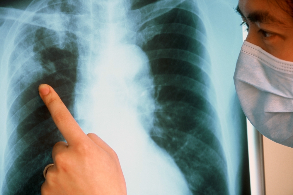 Что является наиболее важным в постановке диагноза туберкулеза у взрослых: